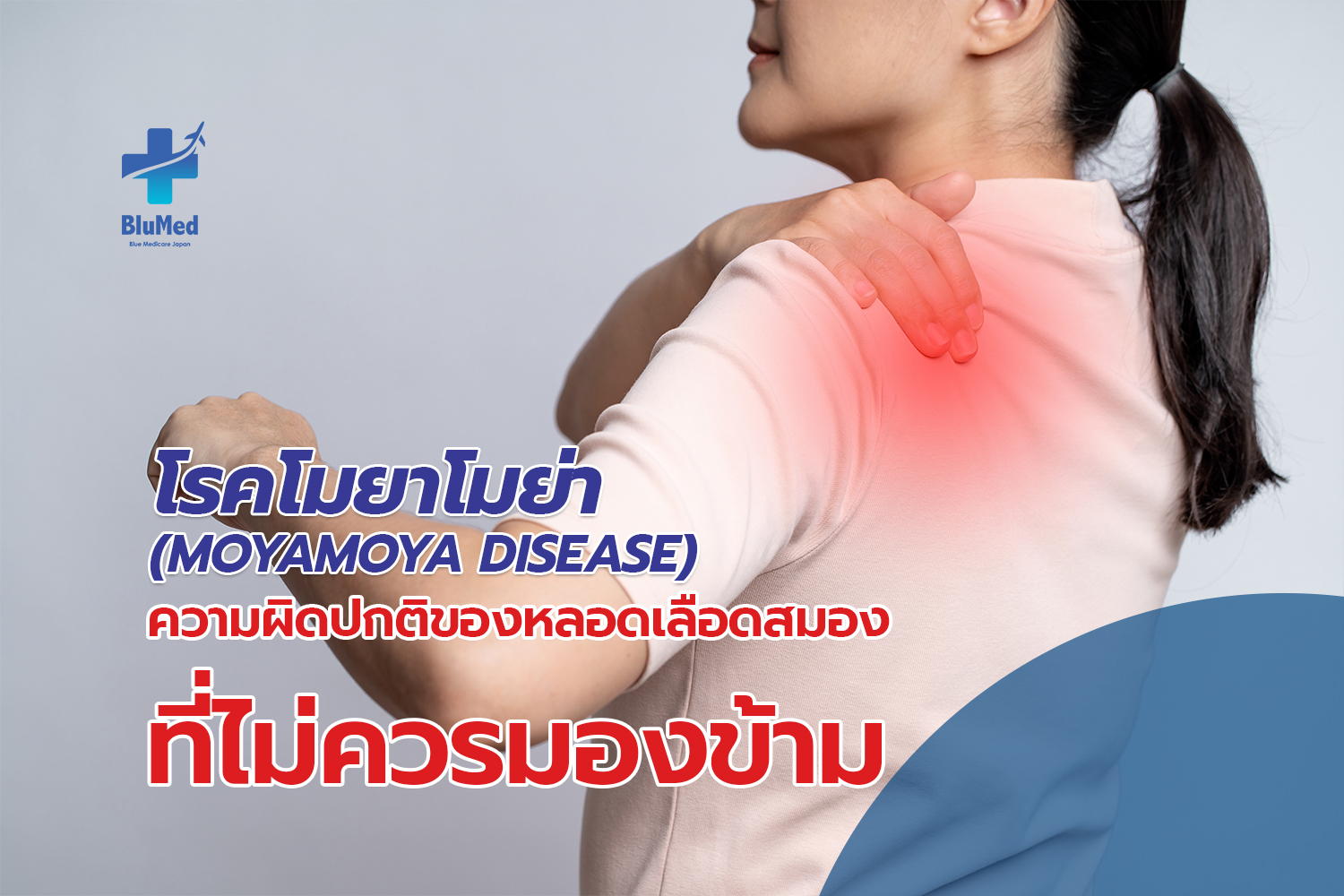 โรคโมยาโมย่า (Moyamoya Disease) ความผิดปกติของหลอดเลือดสมองที่ไม่ควรมองข้าม